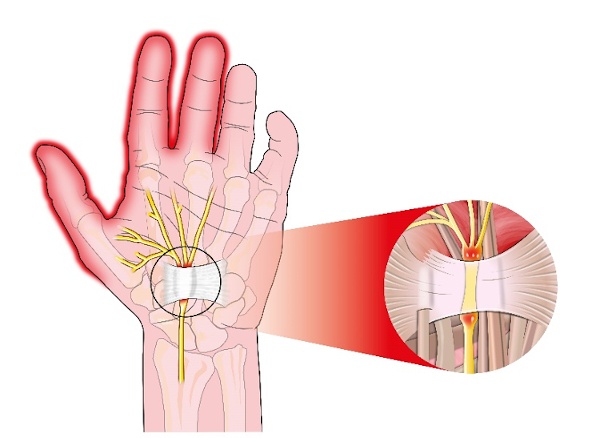 An image of a hand and the ligament.