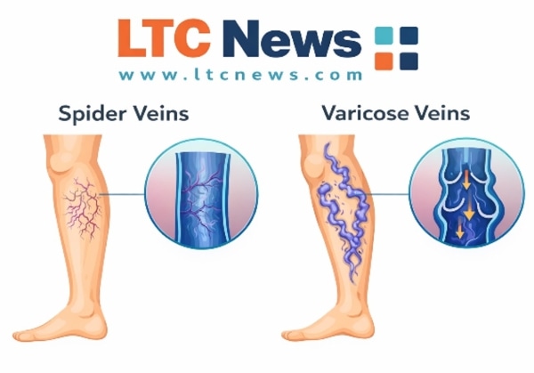 An infographic explaining the difference between spider and varicose veins.